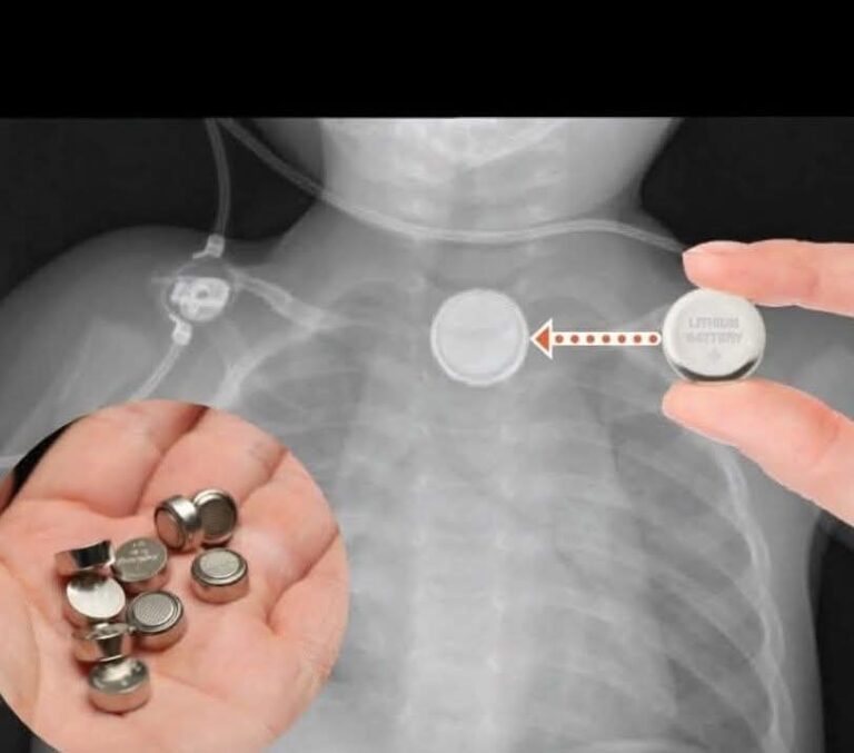 “ছোট্ট বোতাম ব্যাটারি—অবহেলায় শিশুদের জীবনের জন্য ভয়াবহ বিপদ”